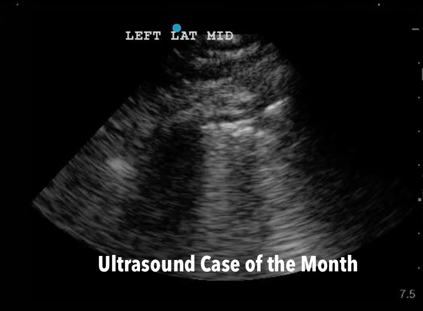 US case of the month - Lung Sonography in CoVID-19