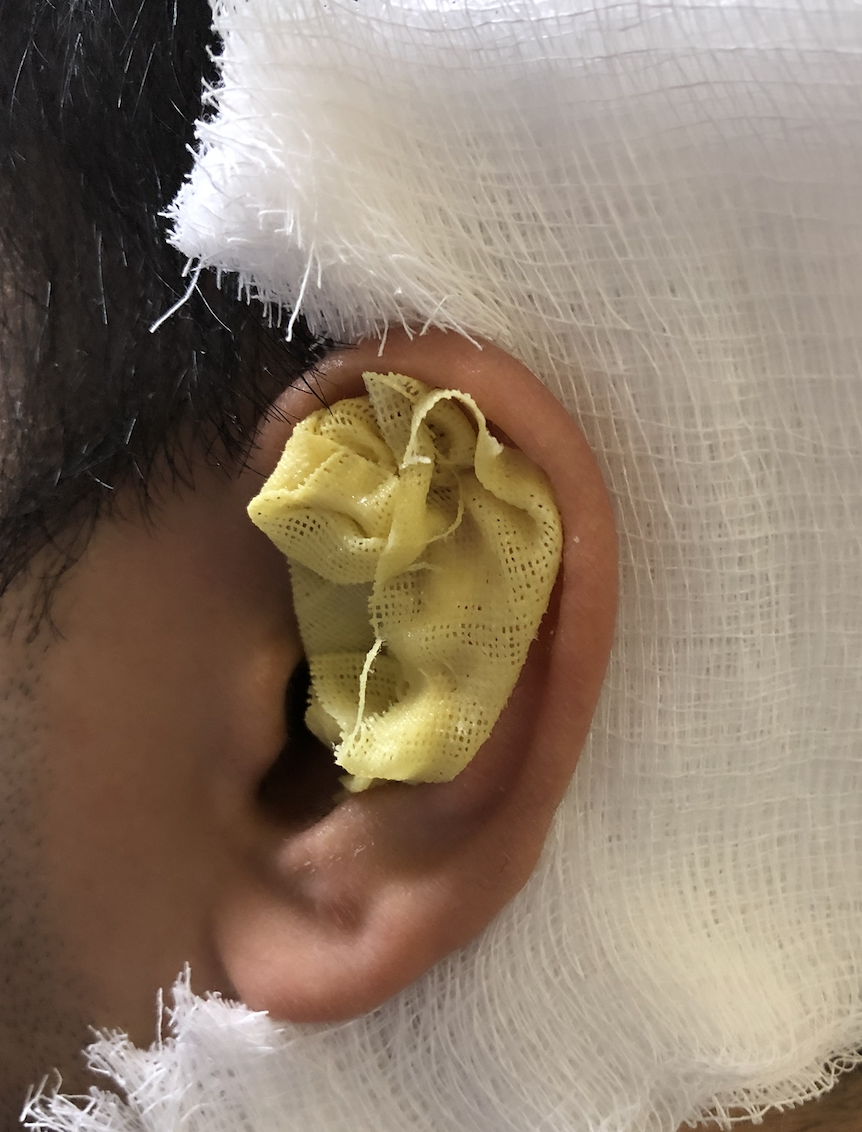 Mastering Minor Care Auricular Hematoma — Taming the SRU