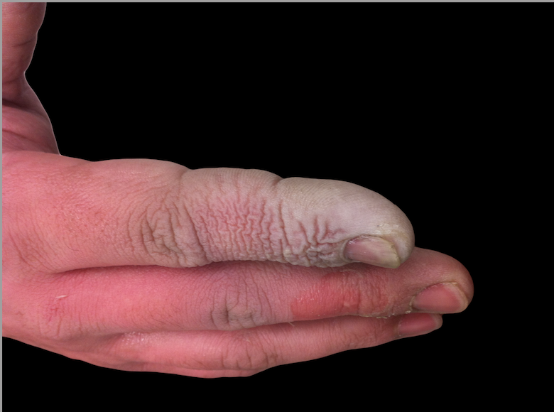 Mastering Minor Care Hydrofluoric Acid Exposure — Taming the SRU