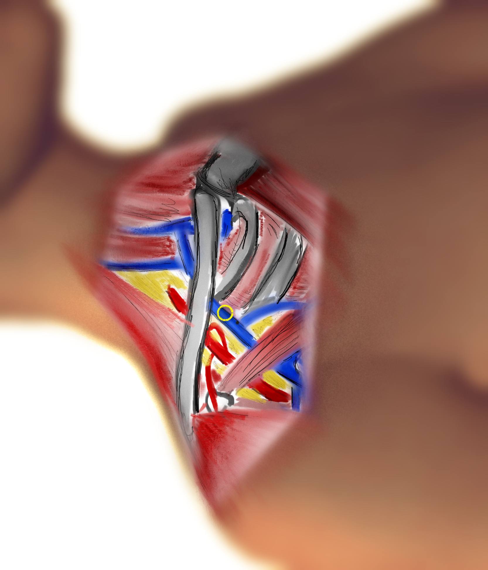 Subclavian Second Layer INFRACLAVICULAR.png
