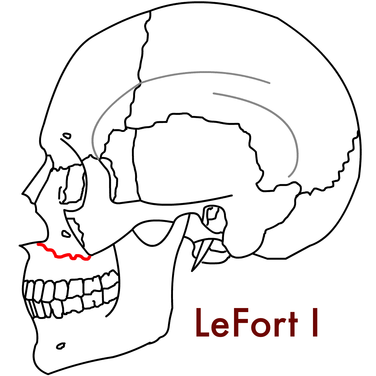 Figure_4a_LeFort_1_Lateral.png
