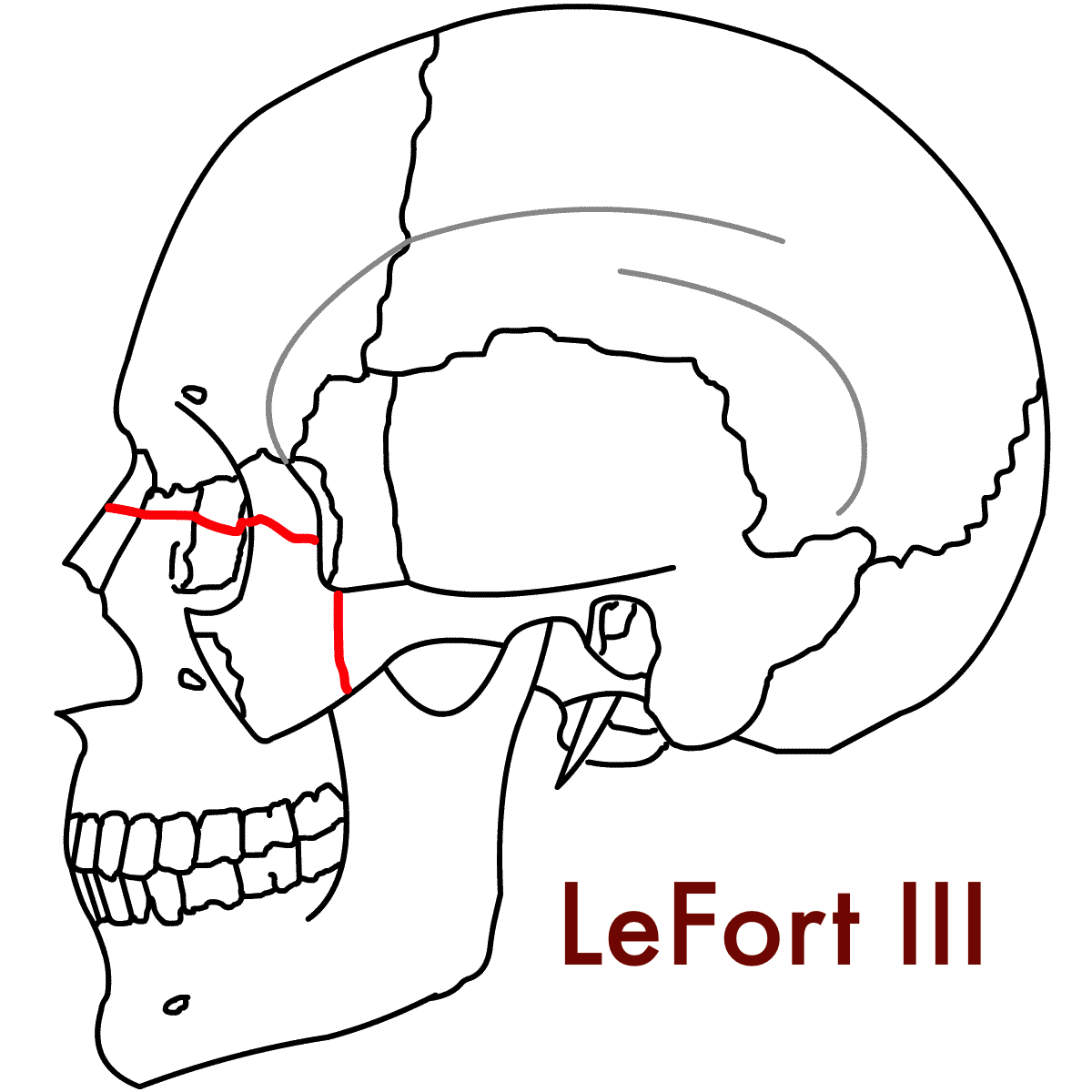 Figure_4c_LeFort_3_Lateral.png