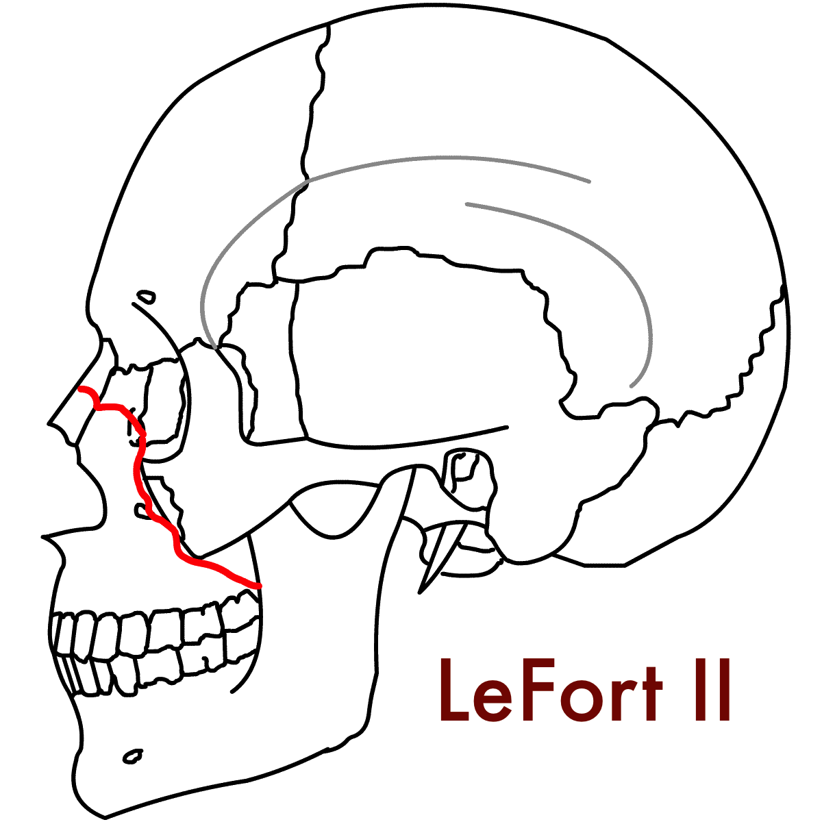 Figure_4b_LeFort_2_Lateral.png