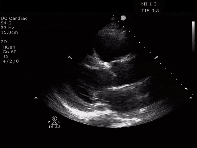 Hennepin Ultrasound  Right Ventricular Strain in Pulmonary Embolism