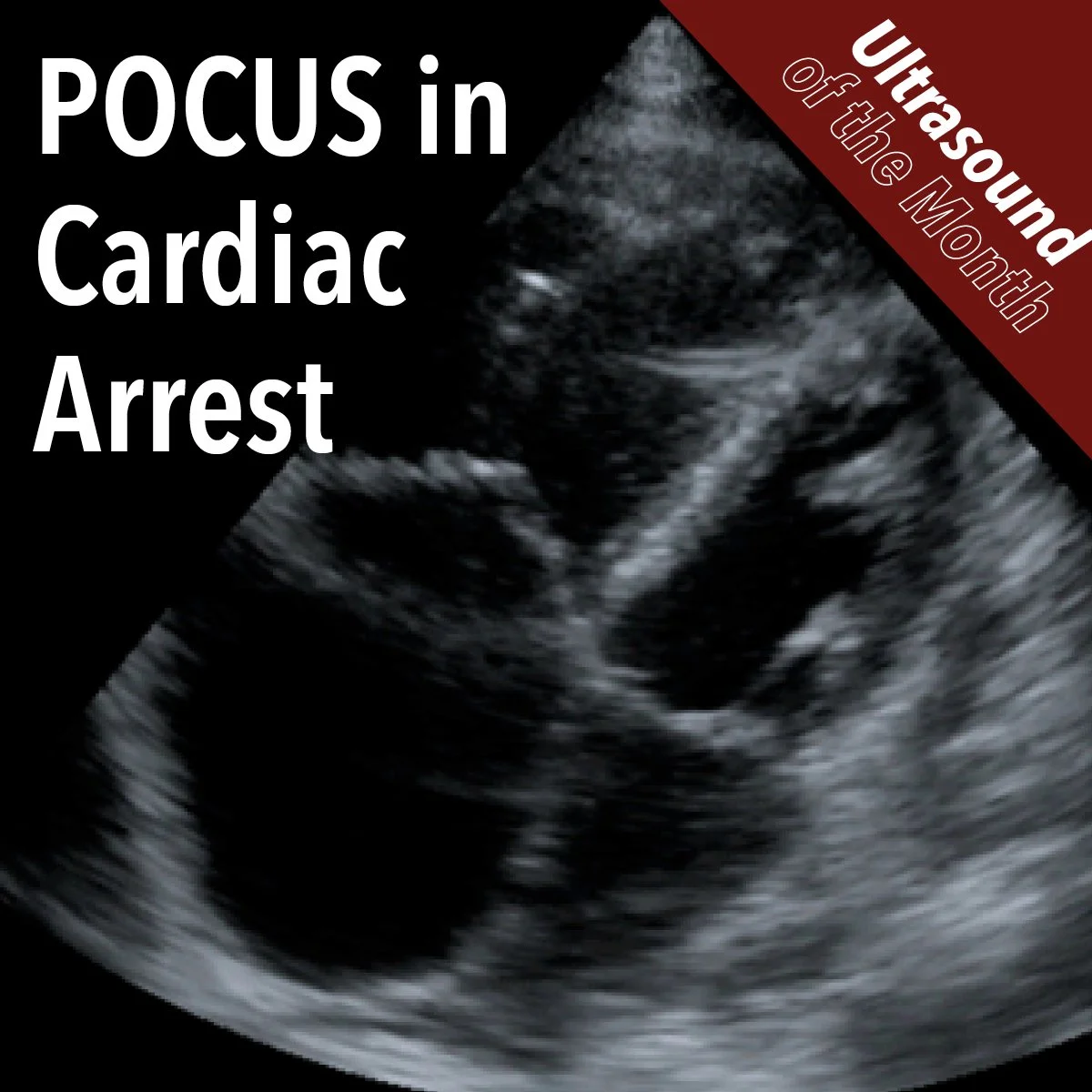 POCUS in Cardiac Arrest