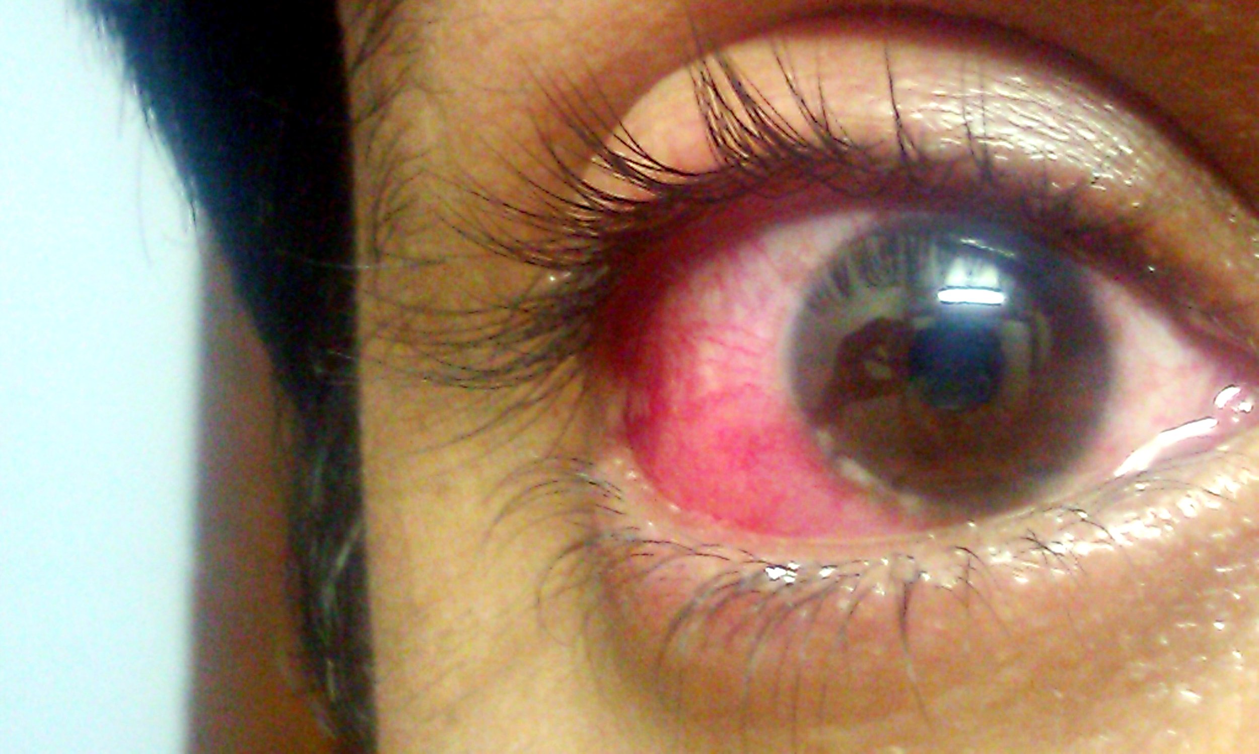 File:Human eye with blood vessels.jpg - Wikipedia