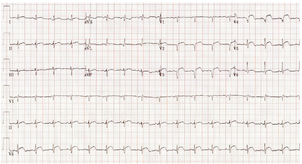 patient was noted to have ST elevation in I, aVL, and V2-V6 with associated Q-wave