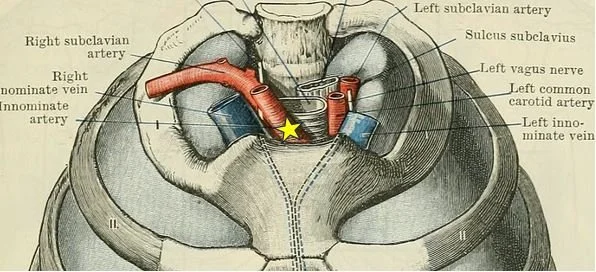 High Riding Innomate Artery Diagnostics and Therapeutics: Tricks of the Trach — Taming the SRU