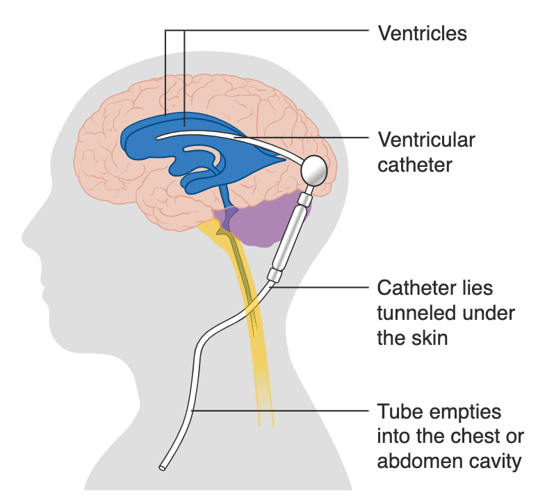 Diagnostics: The Shunt Series — Taming the SRU