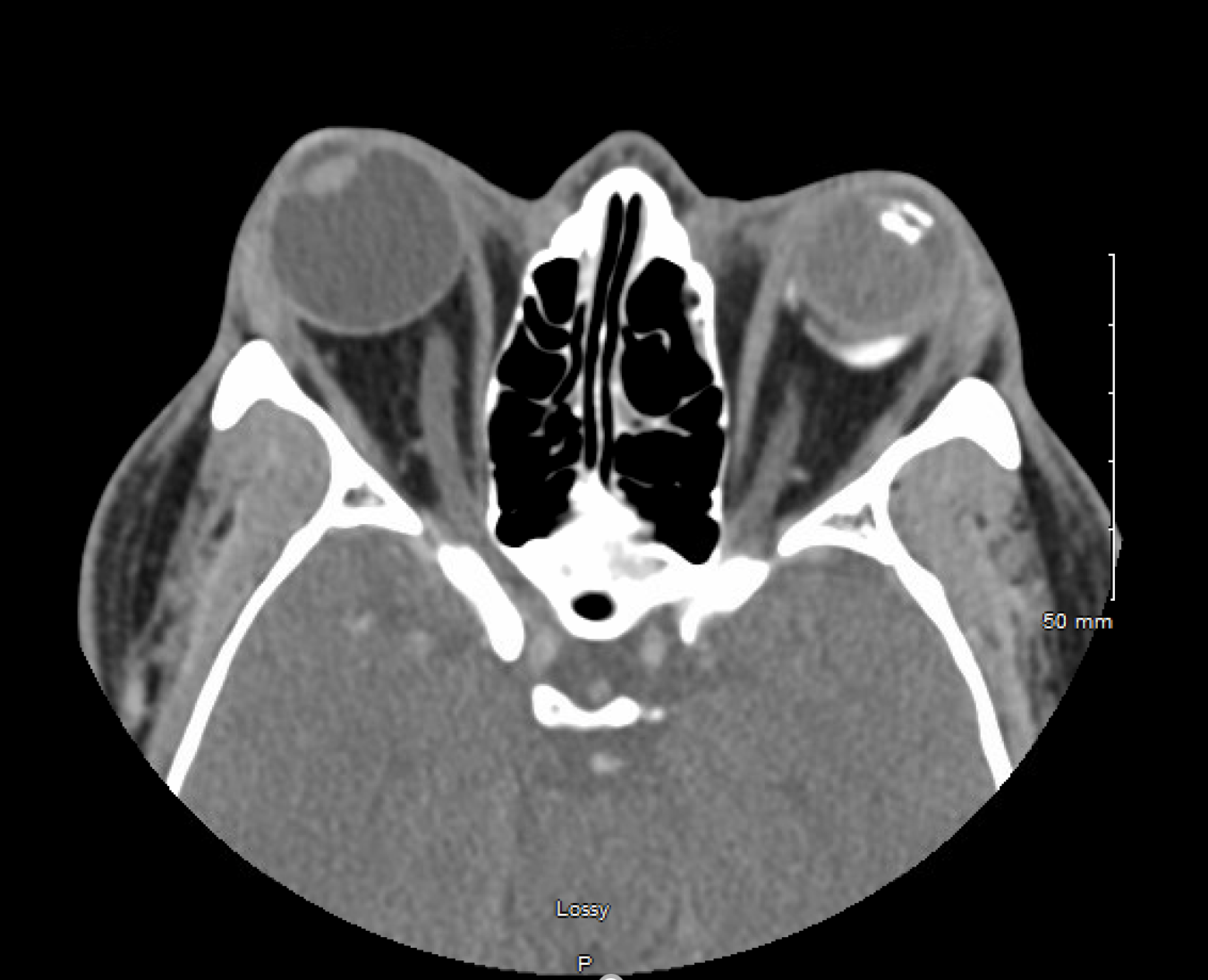 Annals of B Pod: Acute Globe Subluxation — Taming the SRU