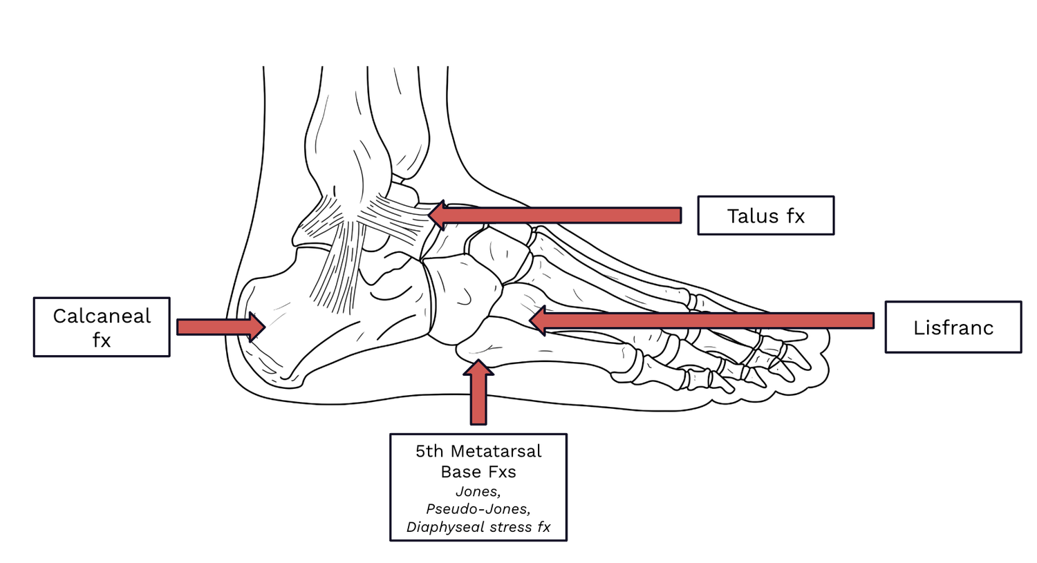 Foot Injuries in the ED — Taming the SRU