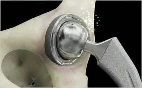 Hip replacement 2.jpg