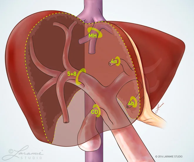 Liver Resection Surgical Procedure (Lobes 4, 5 + 8)