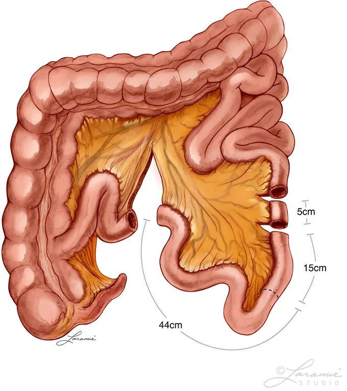 Orthotopic Ileal Neobladder