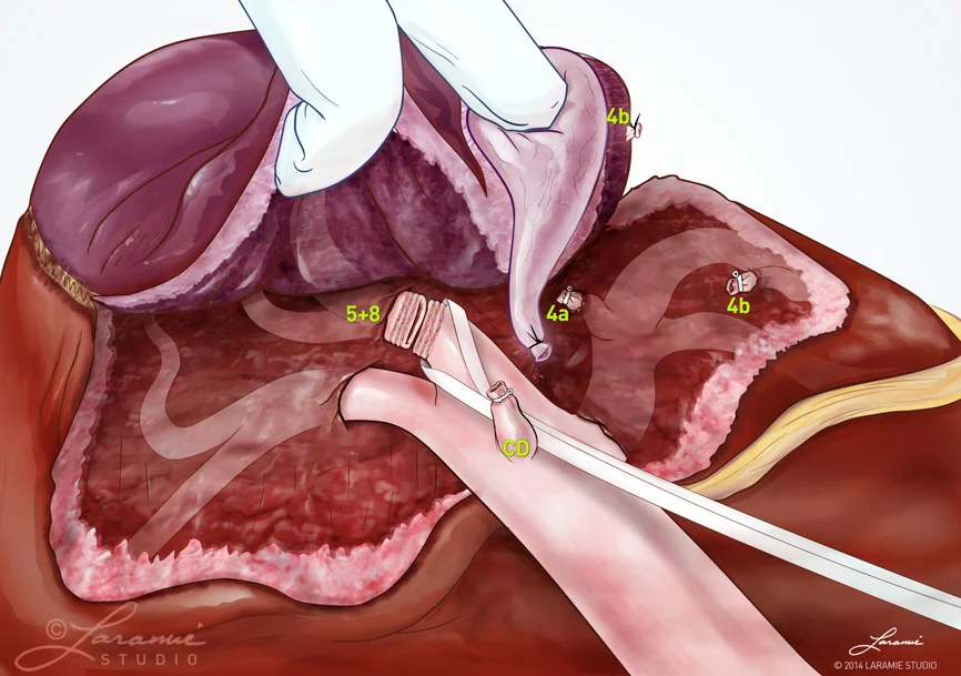 Liver Resection Surgical Procedure (Lobes 4, 5 + 8)