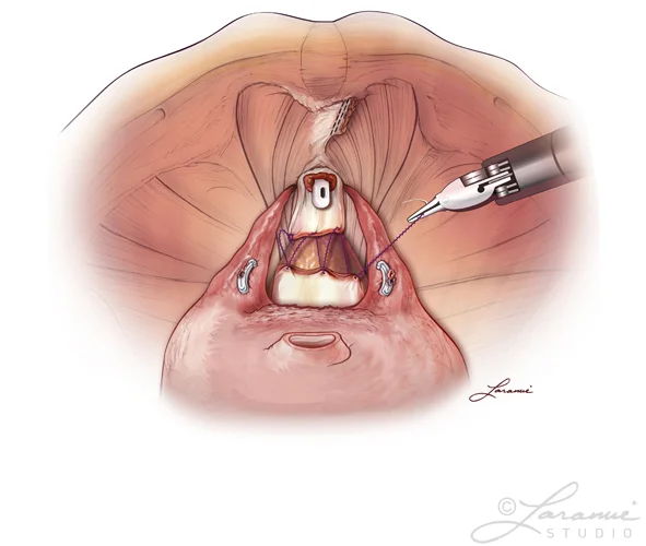 Reapproximation of the Pelvic Floor