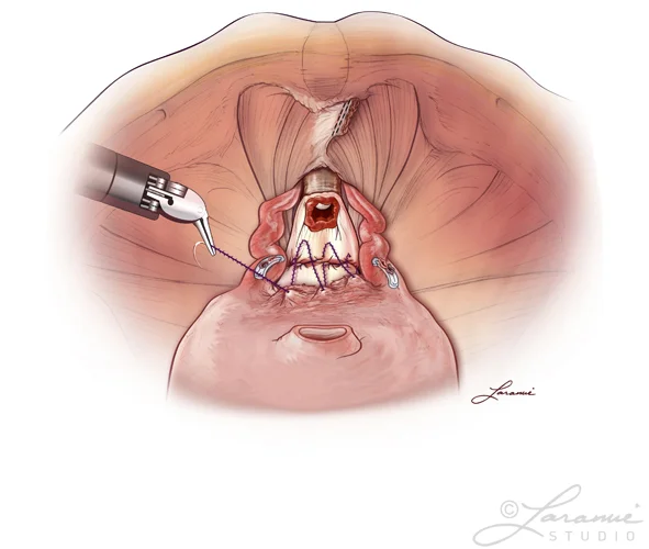 Prostate removal procedure