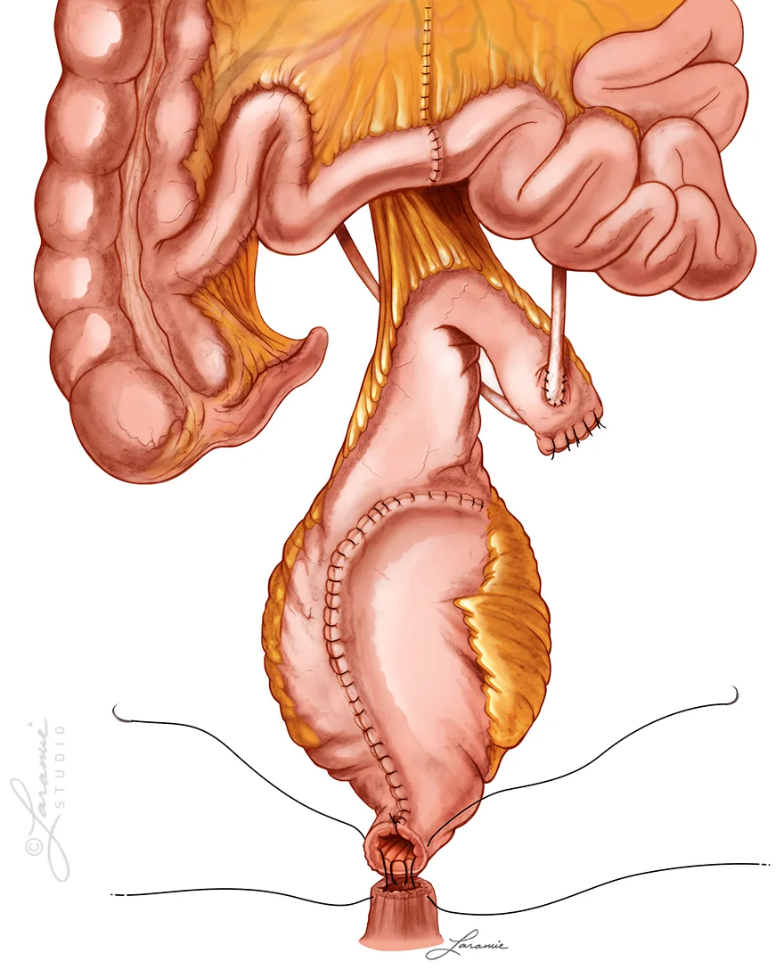 Orthotopic Ileal Neobladder