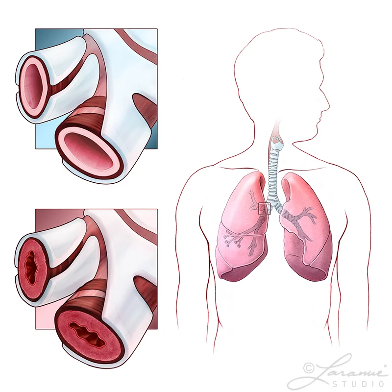 Bronchitis