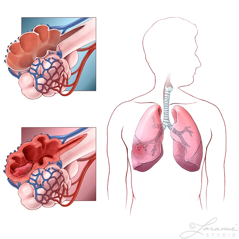 Pneumonitis