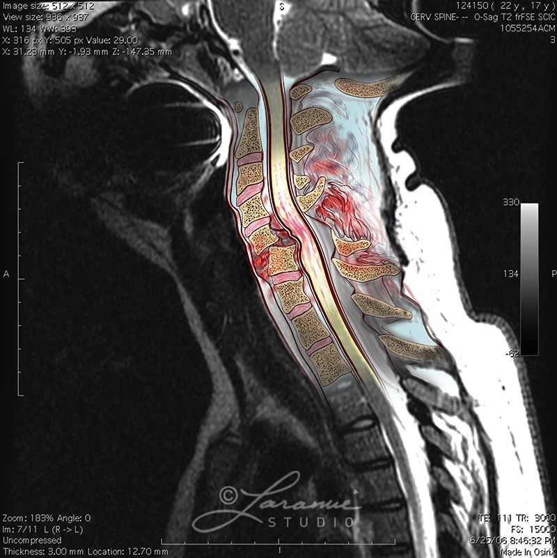 Cervical Injury