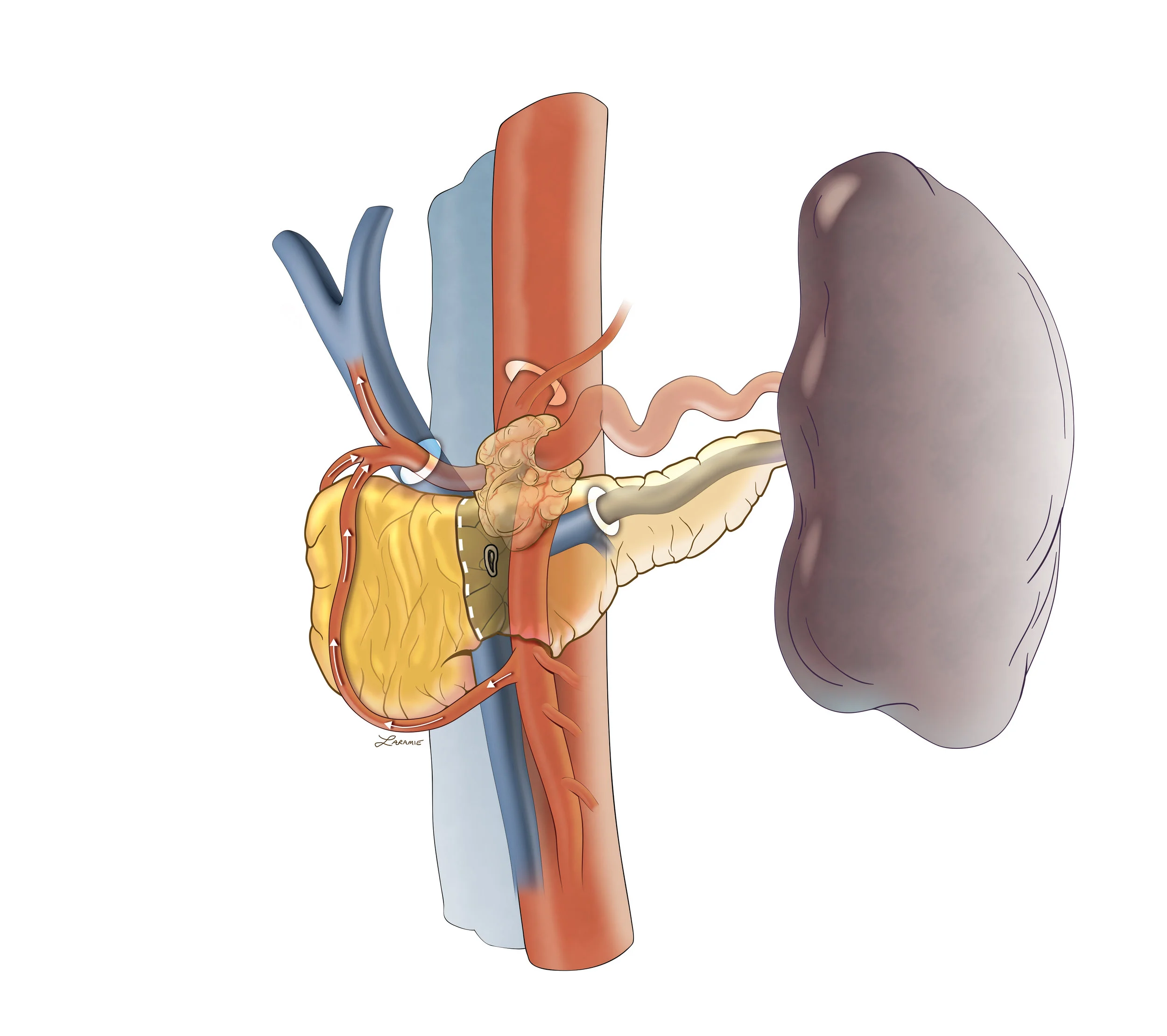 Distal_pancreatectomy_SMV-PV.jpg