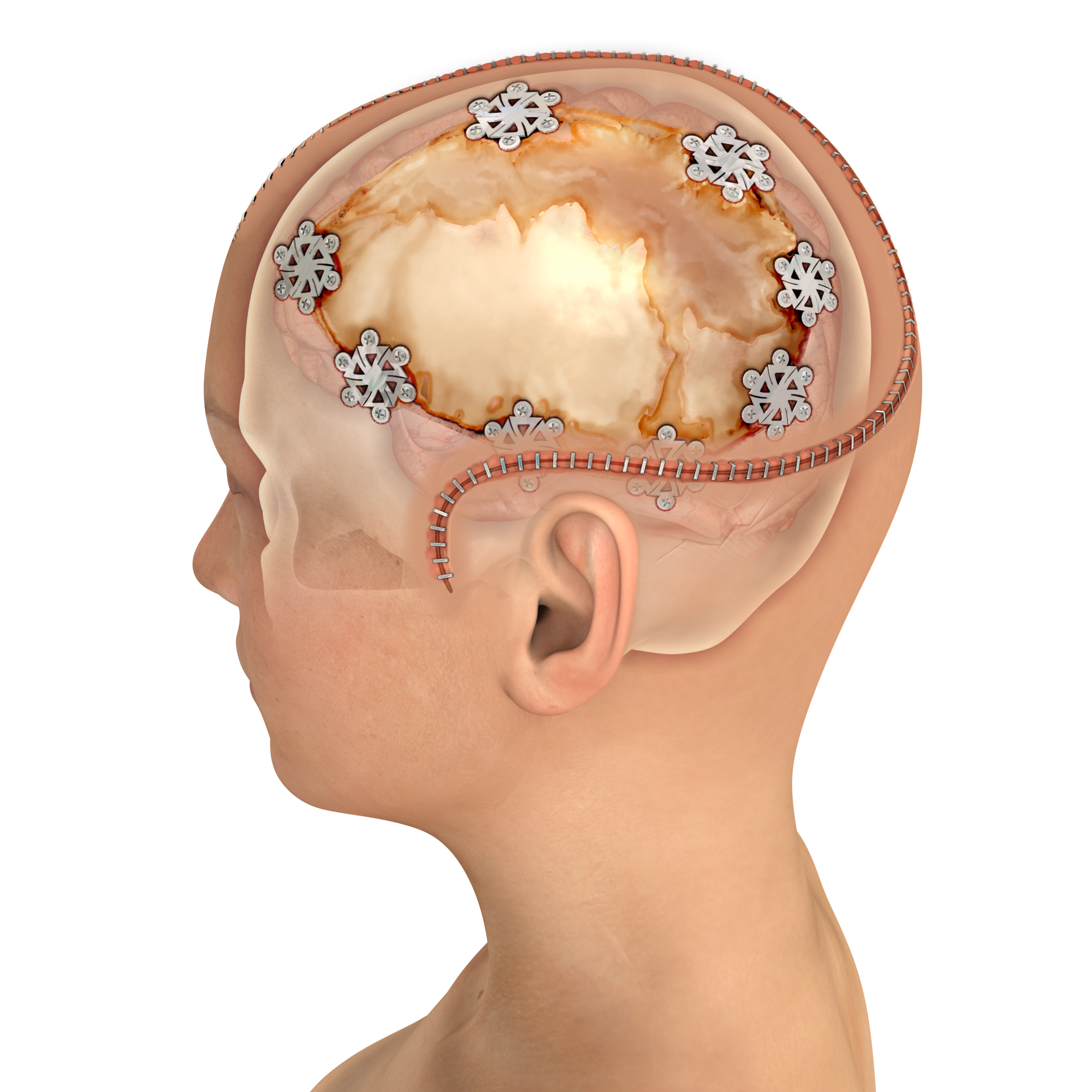 Cranioplasty-revison.png