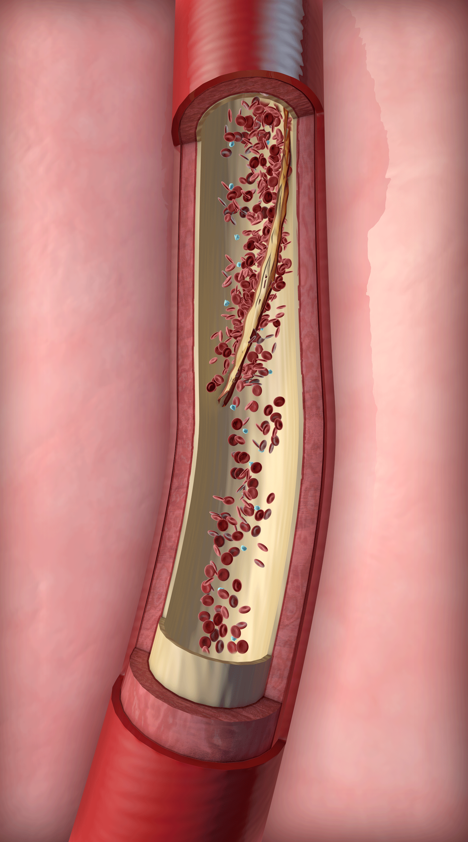 0000_Clotting.png
