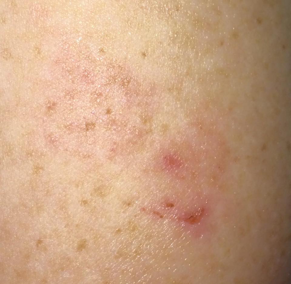 A positive reaction to a patch test carried out at Utopia