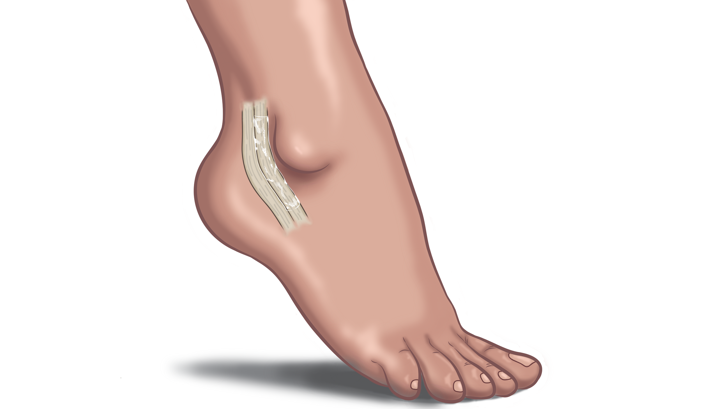Peroneal_Healed-01.png