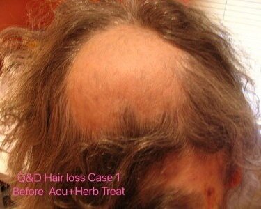 QD Chinese Acupuncture, Herb and Massage. Cork. Testimonials-Hair Loss —  Q&D Acupuncture and Herb Clinic