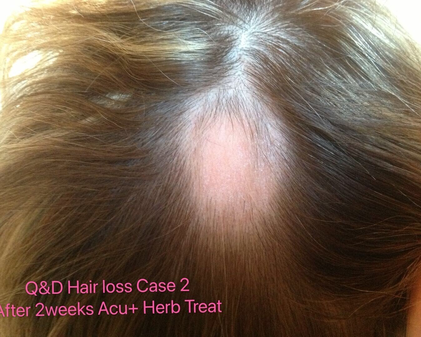 QD Chinese Acupuncture, Herb and Massage. Cork. Testimonials-Hair Loss —  Q&D Acupuncture and Herb Clinic