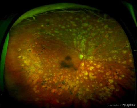 Post Laser Treatment for Severe Diabetic Retinopathy