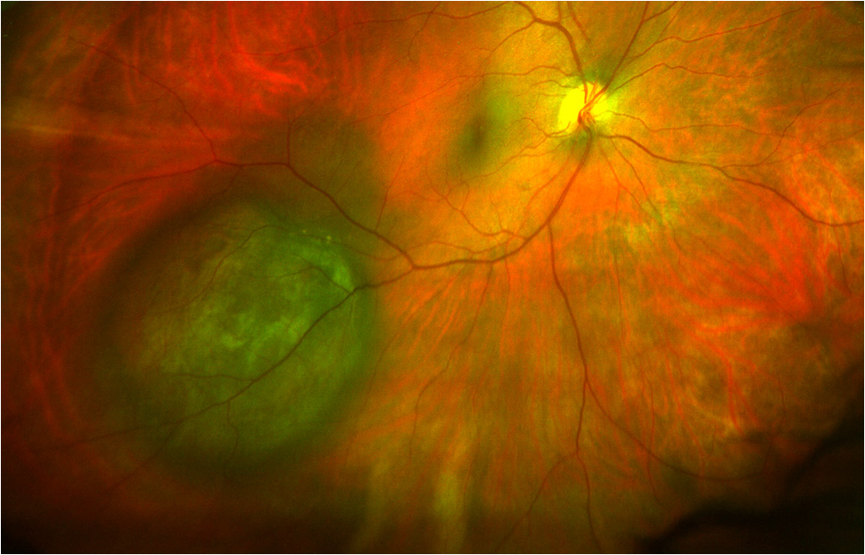 Malignant Melanoma