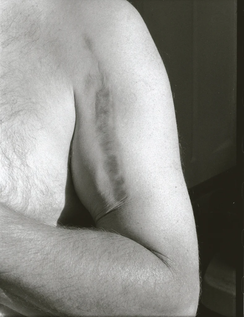 Scar