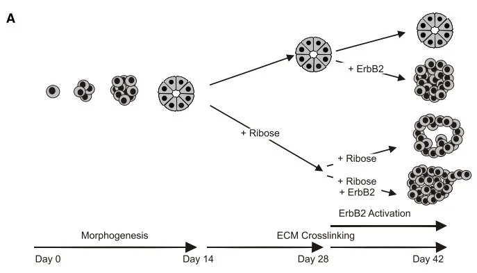 Matrix stiffness leads to cancer progression. ErbB2 is a growth factor receptor that is amplified in many breast cancers. In this experiment ribose treatment leads to ECM stiffening. Either GFR amplification or ECM stiffening breaks down the organization of acinii, but both are required for metastatic outgrowth. Taken from reference 3.