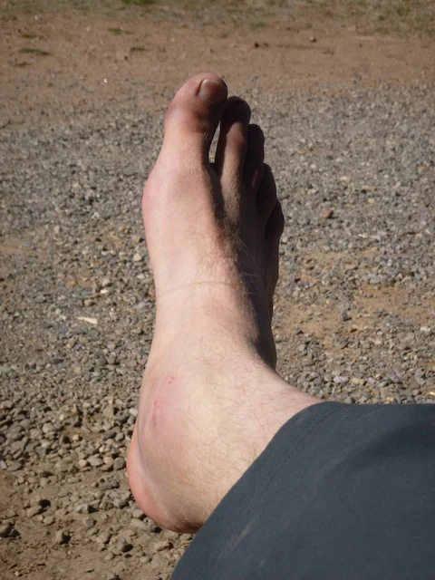 My ankle starting to swell the morning after