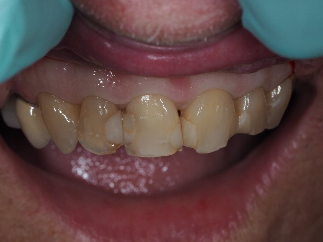  patient came in with chipped teeth and failing front fillings.  