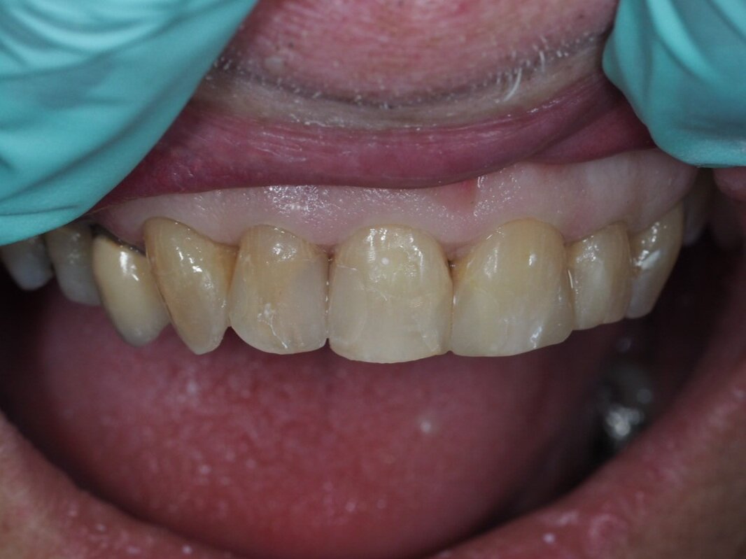  The fillings were replaced, restoring the overall appearance of the smile. 