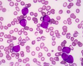 An intensive pediatric-like acute lymphoblastic leukemia (ALL) treatment protocol was associated with a good response rate.