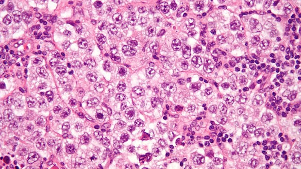 Germ tumor cells