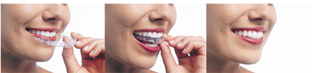 Invisalign - the clear alternative to braces