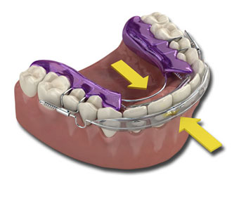 The Inman Aligner gentle "squeeze" effect.