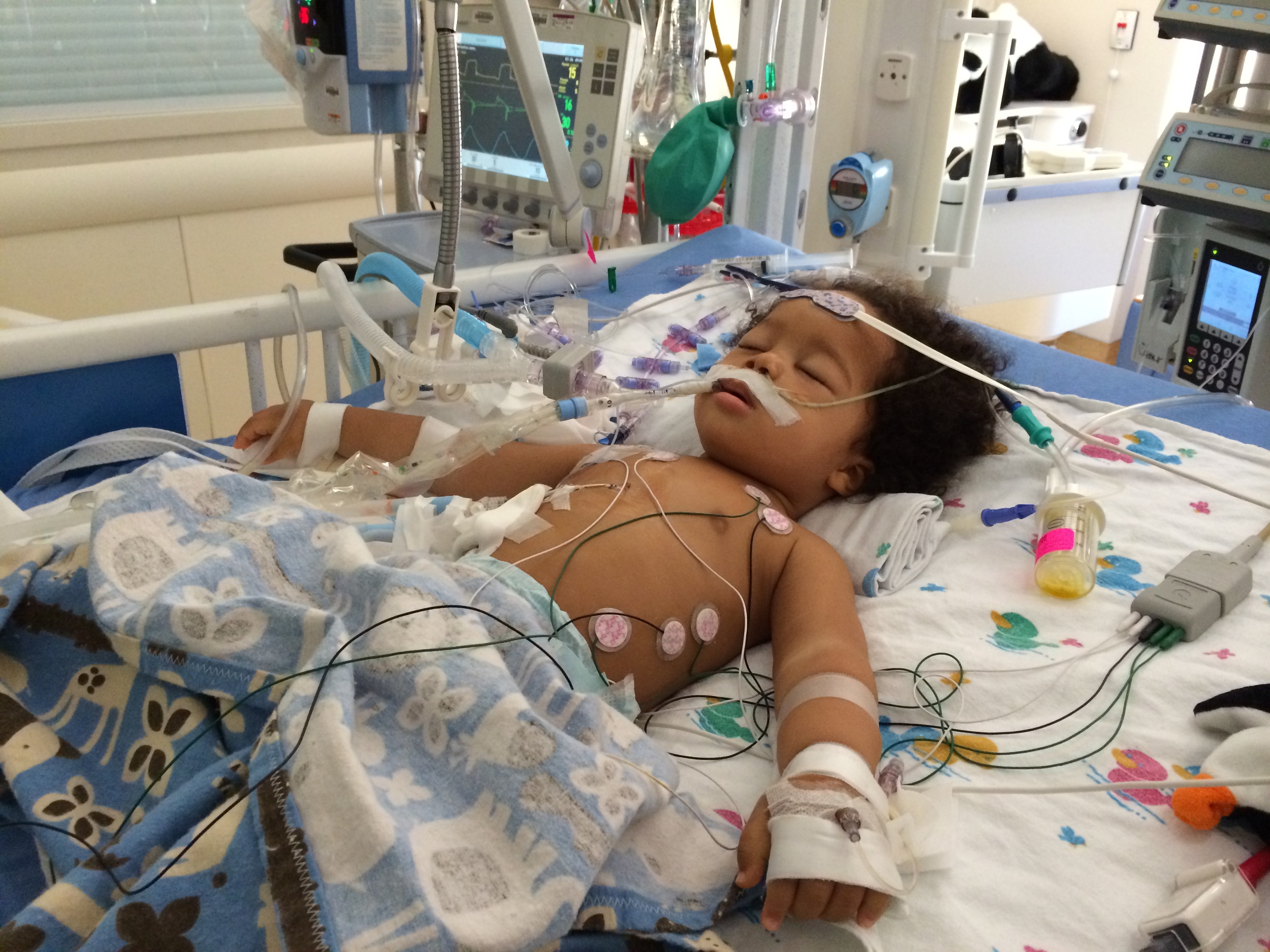 Elliott: Day of diagnosis: July 24, 2014 (intubated, chest tube (to drain fluid around lungs), pericardial drain (to drain fluid around heart)...fully monitored. While this photo is difficult to look at, seeing him struggle to breathe was much worse.