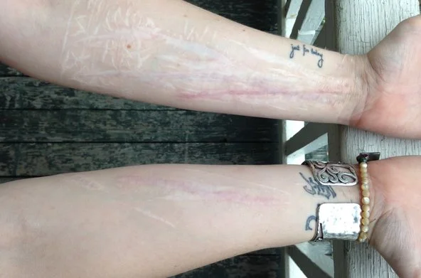 Understanding Adolescent Self-Injury and Accessing Help