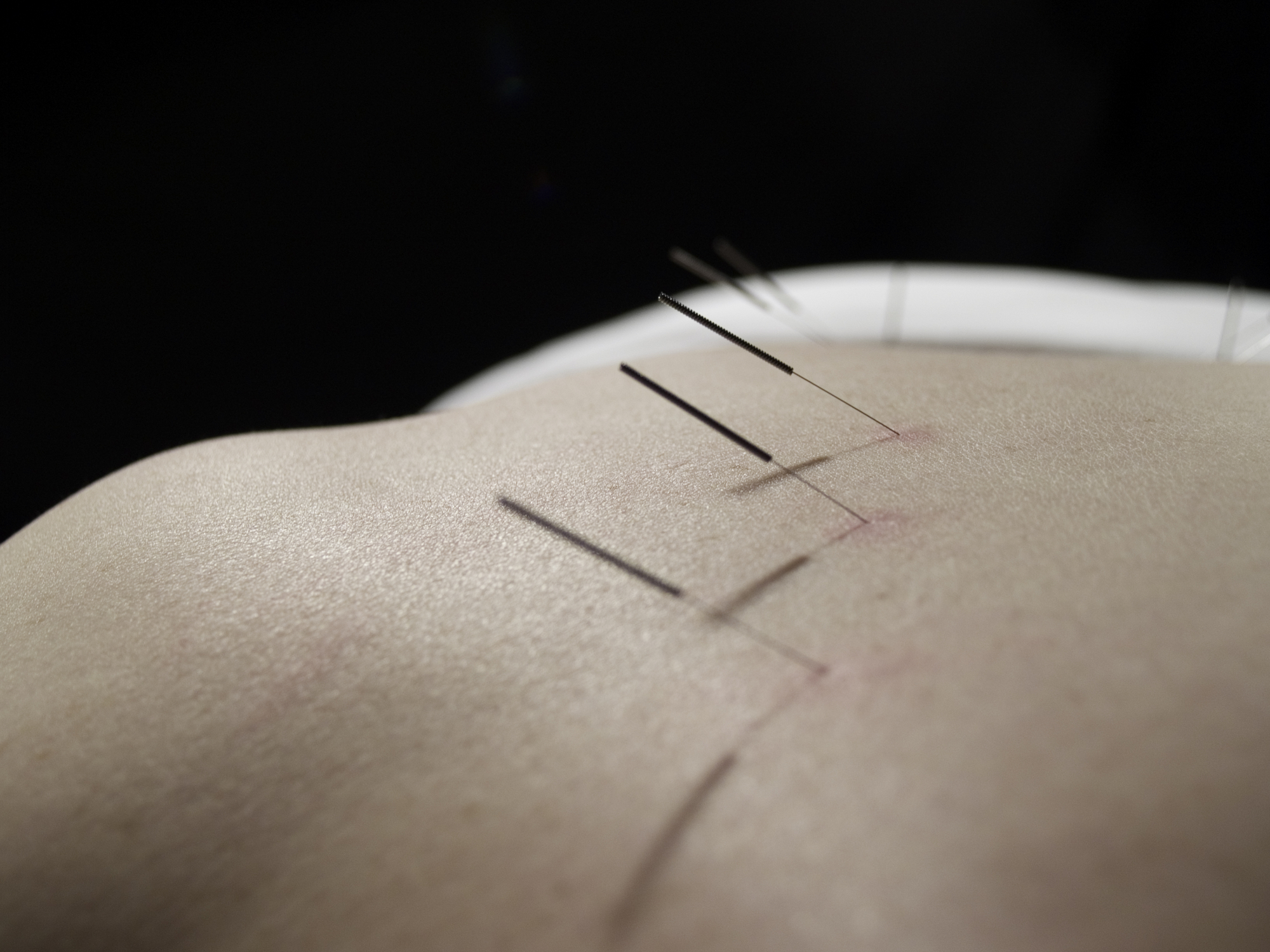 acupuncture.jpg
