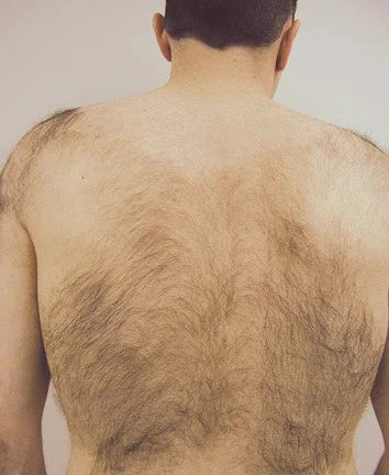 Before After Laser Hair Removal Before After Seduire