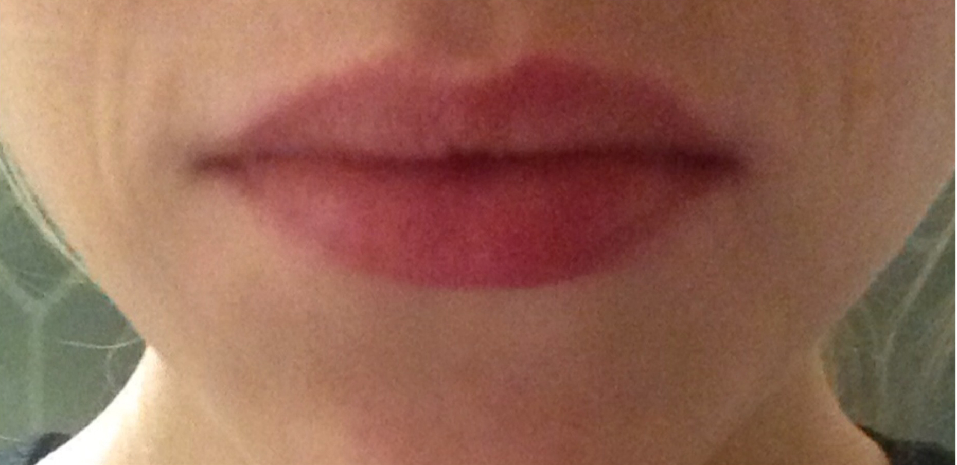 Before & after Lip Plump Before and After — Seduire London Laser