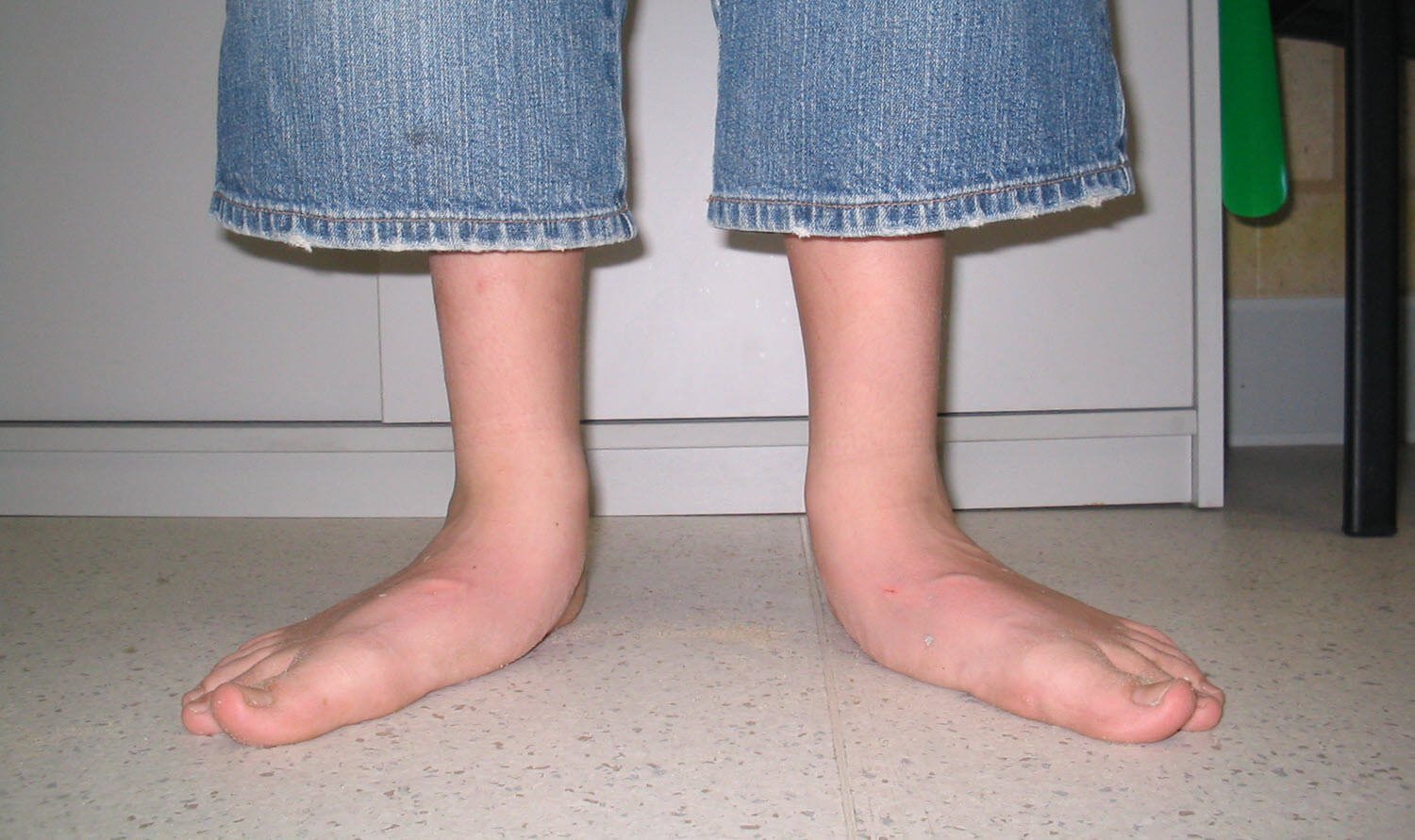 Flat feet .jpg