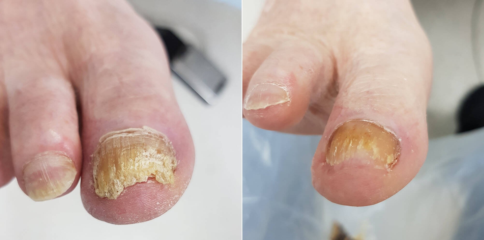 thick fungal toenail before and after 2 (2).jpg